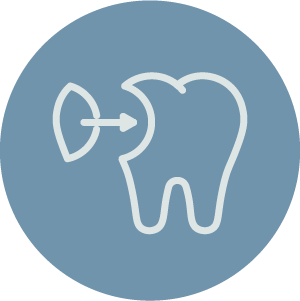 Tooth colored filling in teeth